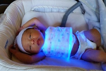 درمان نوزادان مبتلابه زردی با فیبر نوری